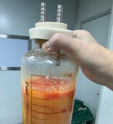 滕州水动力吸脂手术要做多久？
